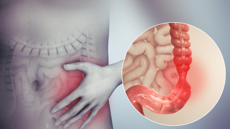 全球市場和炎症性腸病